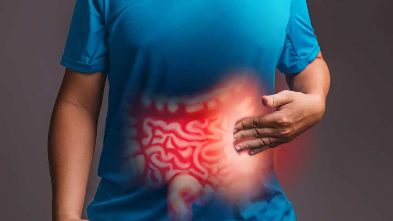 Colon Cancer
