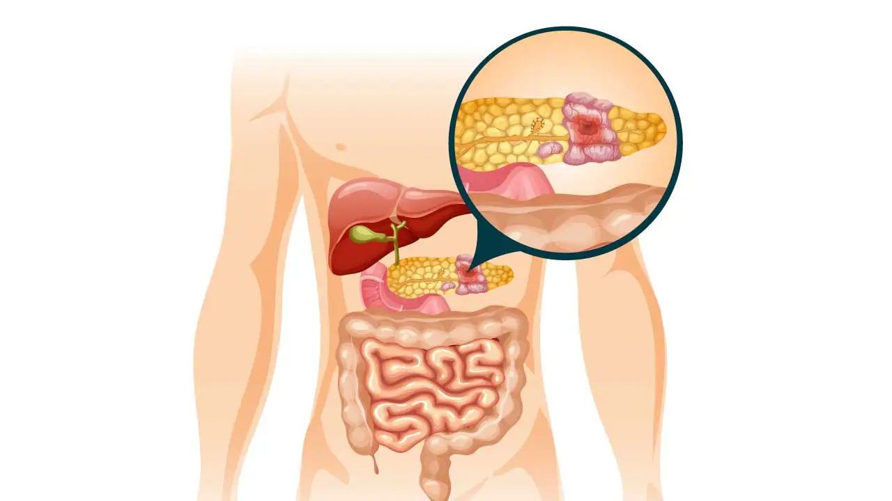 Pancreatic Cancer