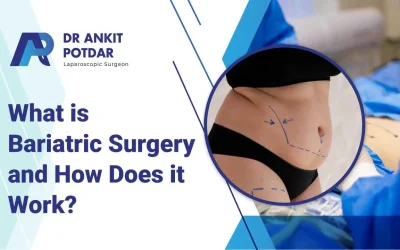 What is Bariatric Surgery and How Does it Work? 