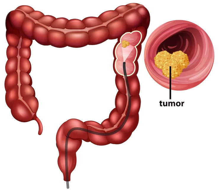 Colon Cancer Surgeon in Mumbai